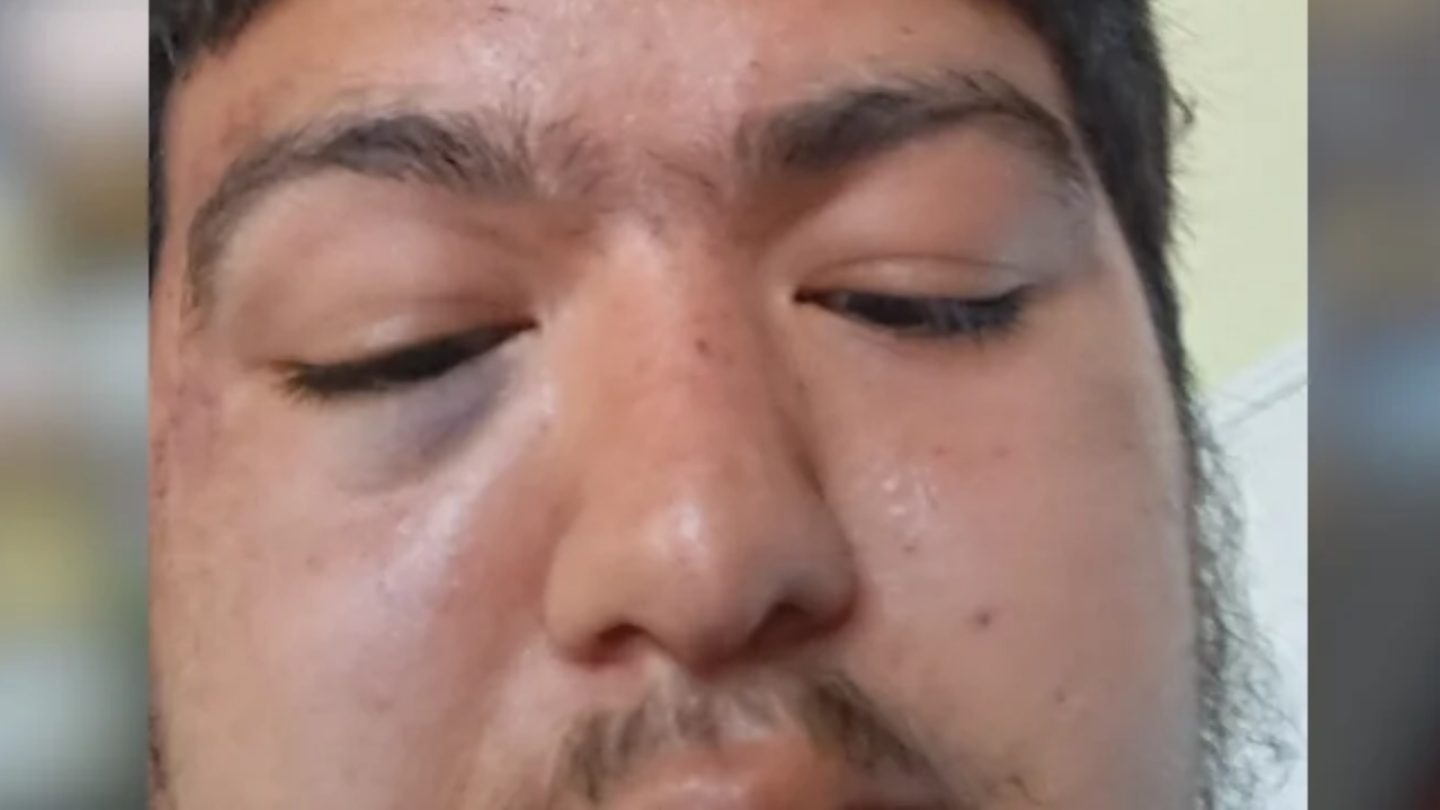 Santa Maria resident Erik Zepeda claims he was injured by ICE agents on Tuesday